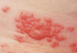 Treatment of Skin Rashes