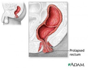 Rectal Prolapse Causes Symptoms Treatment And Surgery