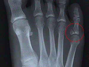 Broken Toe – Symptoms, Diagnosis, Treatment and Pictures