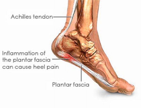 Heel Pain – Causes, Treatment and Cure