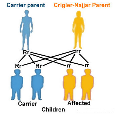 Crigler Najjar Syndrome Types, Symptoms, Causes, Prevention, Treatment
