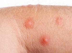 Cherry Angioma - Causes, Pictures, Diagnosis, Treatment ...