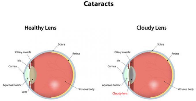 Infant Cataract - Types, Symptoms, Diagnosis And Treatment!